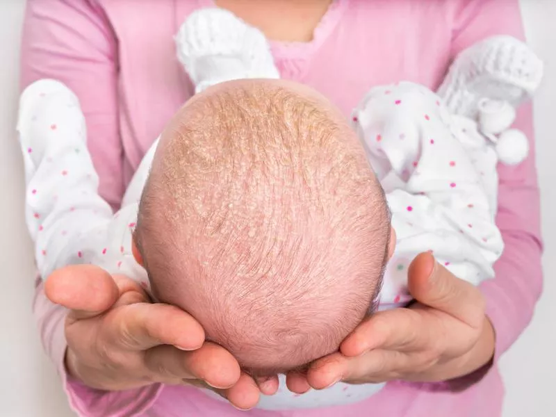 Cradle Cap