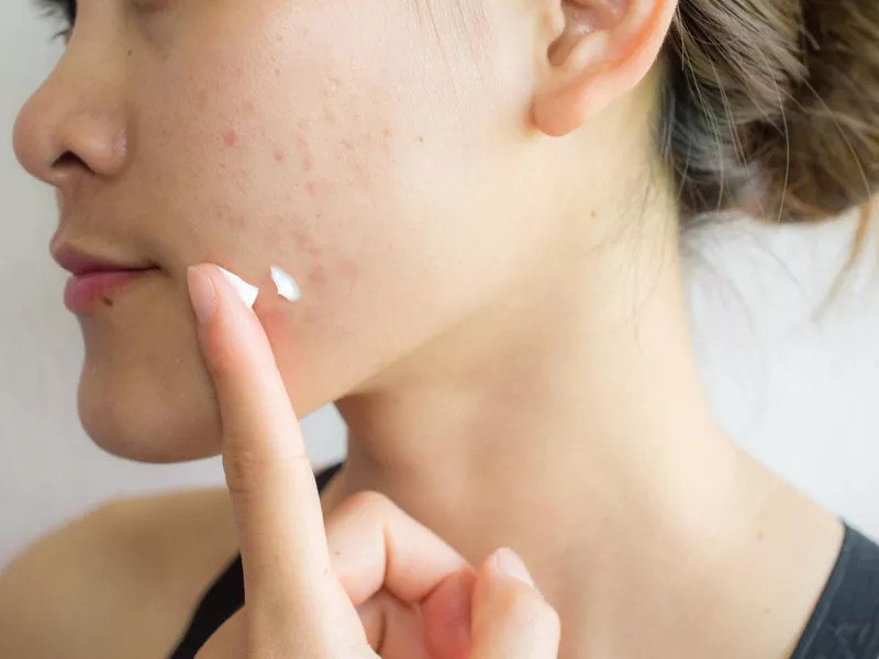 Portrait of young Asian woman having acne problem. Applying acne cream on her face.